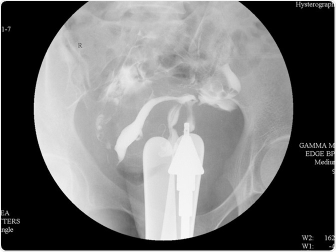 Hysterosalpingography (HSG) is a fluoroscopic X-ray study of a woman's uterus and fallopian tubes. Image Credit: Whitetherock photo / Shutterstock